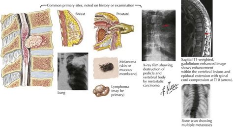 Spinal Cord Tumors Neupsy Key