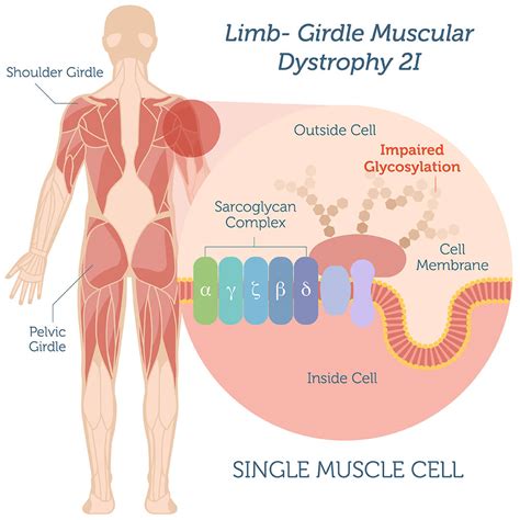 Limb-Girdle Muscular Dystrophy Type 2I - Genebase