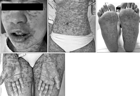 Scielo Brasil Stevens Johnson Syndrome And Toxic Epidermal Necrolysis