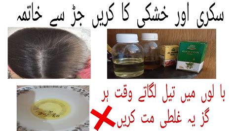 How To Remove Dandruff Permanently In Days How To Treat Dandruff