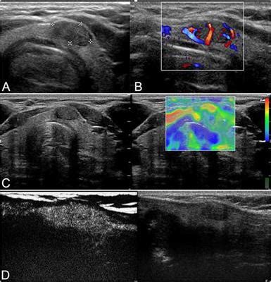 Frontiers Differentiation Of Thyroid Nodules Difficult To Diagnose