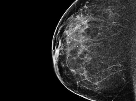 When You Need A Mammogram Should You Get One In 3 D Iowa Public Radio