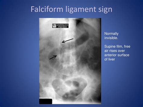 Ppt Abdominal X Ray Radiological Signs Powerpoint Presentation Free