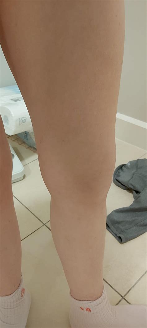 Inner Knee Fat Best Method To Remove Or Slim Down Bulge Above Knee Joint Tried Exilis 8