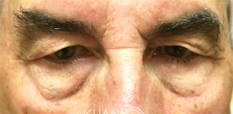 25 Upper Eyelid Surgery Before And After Photos Dallas Plano Texas Cosmetic Reconstructive