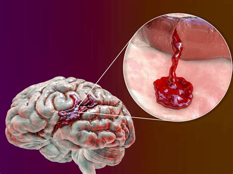 Enfermedad Cerebrovascular Hemorrágica Qué Es Y Su Fisiopatología