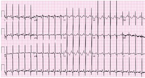 Pulmonary Atresia With Intact Ventricular Septum Thoracic Key