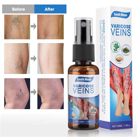 5x Vein Healing Varicose Veins Treatment Spray Veinhealing Varicose