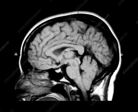 MRI of Chiari I Malformation - Stock Image - M130/0949 - Science Photo Library