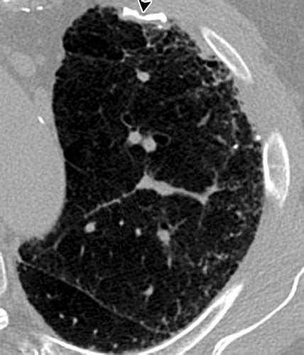 State Of The Art Imaging Of Occupational Lung Disease Radiology