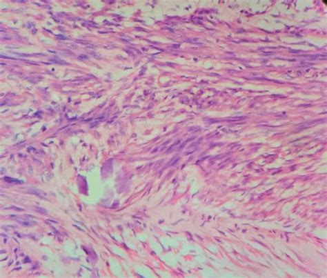 Histology Showing Intersecting Fascicles Of Spindle Cells With