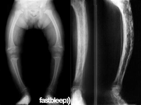 Congenital Syphilis