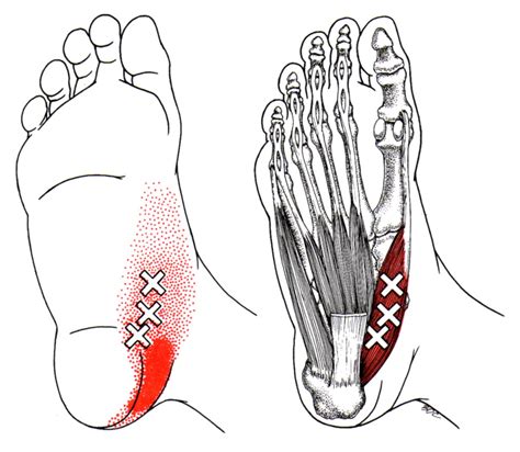 Abductor Hallucis | The Trigger Point & Referred Pain Guide