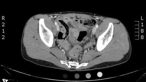 Appendicitis On Ct Scan