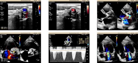 Ecmo Tavr Pci