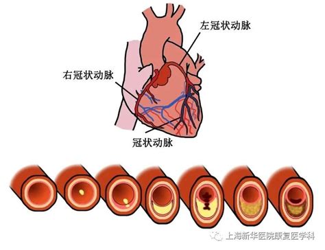 运动与冠状动脉粥样硬化性心脏病的那些事儿澎湃号·湃客澎湃新闻 The Paper