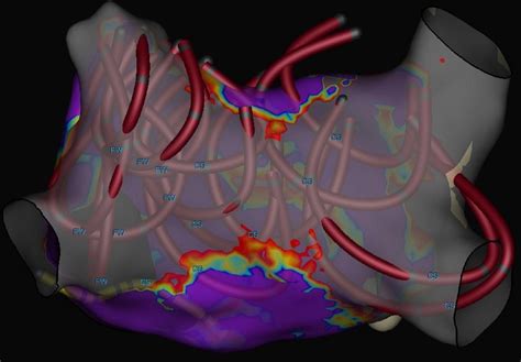 Frontiers Initial Experience With Pulsed Field Ablation For Atrial