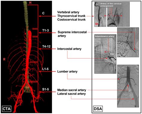 Artery Of Adamkiewicz Diagram