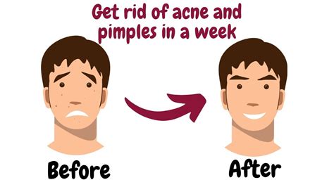 Easy Ways To Get Rid Of Acne Easy Remedies For Clear Skin Youtube