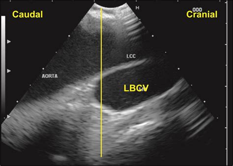 Techniques Of Linear Endobronchial Ultrasound Intechopen