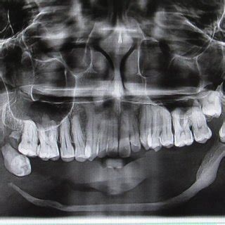 Orthopantomograph Showing Resorption Of The Mandibular Arch And