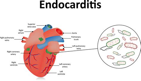 What is endocarditis? - Symptoms and Causes | Dr Raghu