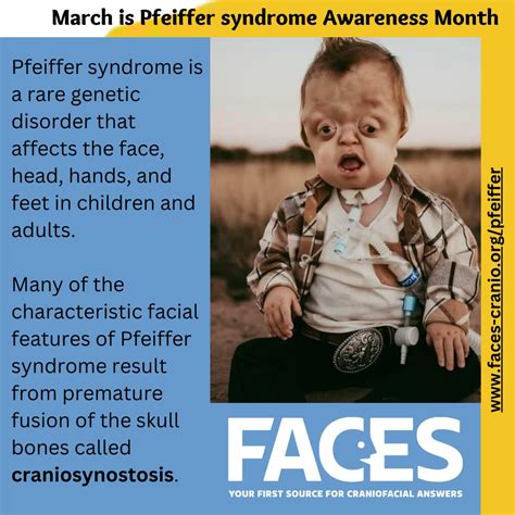 pfeiffer syndrome   rare genetic disorder    births