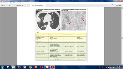 Pulmonary Vascular Disease Pptx D Majeed Muhadharaty