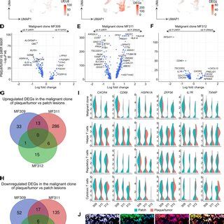 Differential Gene Expression Between Plaque Tumor And Patch Lesions Is