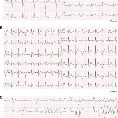 A A Resting Lead Electrocardiogram Exhibiting First Degree