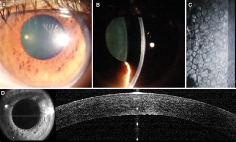 a, b One month follow-up- complete resolution of corneal edema; c ...