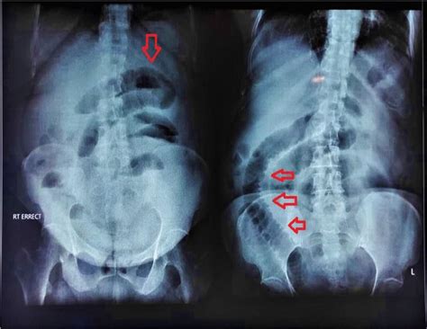 Erect X Ray Abdomen Showing Valvulae Conniventes And Featureless Ileum Download Scientific