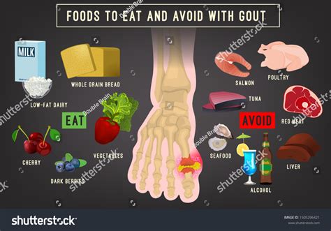 Gout Arthritis Infographic Royalty Free Vector Image Hot Sex Picture