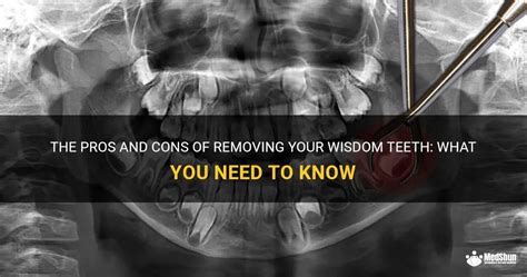 The Pros And Cons Of Removing Your Wisdom Teeth What You Need To Know Medshun