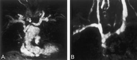 Contrast Enhanced Mr Angiograms Show Left Brachiocephalic Vein Stenosis Download Scientific