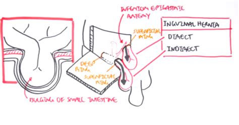 Abdominal Hernias Flashcards Quizlet