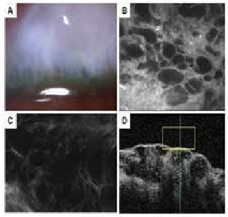 Microcystic Bleb A Biomicroscopic View Of A Bleb With Microcysts And