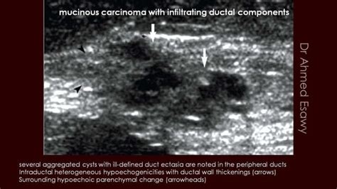 Breast Duct Ectasia Us Mammogram Mri