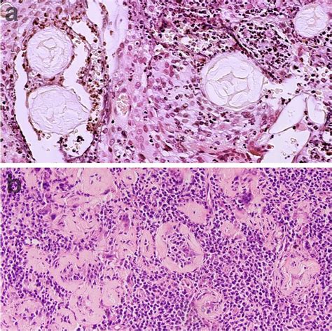 A Granuloma Inciting Cells With Cellulose Cell Walls And Starch