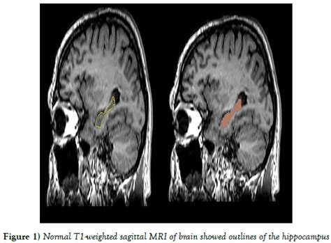 Hippocampal Volumetric Variations In The Normal Human Brain By Magnetic