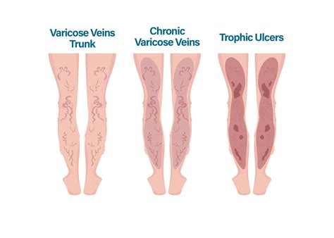 Varicose Veins: Symptoms and Treatment Options — Physicians Vein Clinics