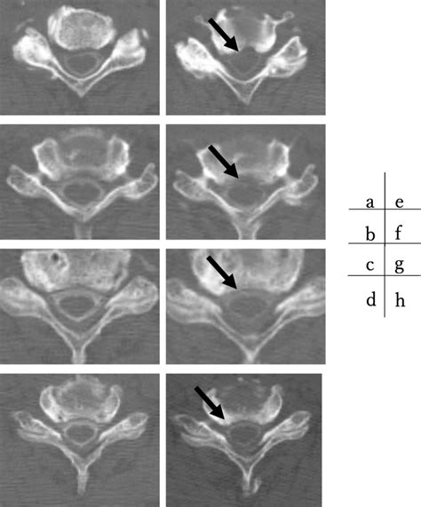 Post Myelogram Dynamic Computed Myelography Post Myelogram Computed Download Scientific