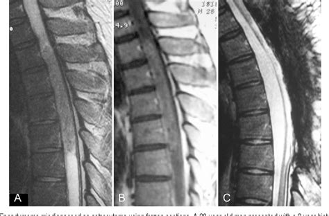 Figure 1 From Intramedullary Spinal Cord Ependymoma And Astrocytoma