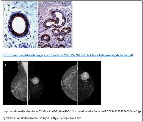 Patolog As Benignas Y Malignas De La Gl Ndula Mamaria Su Epidemiolog A