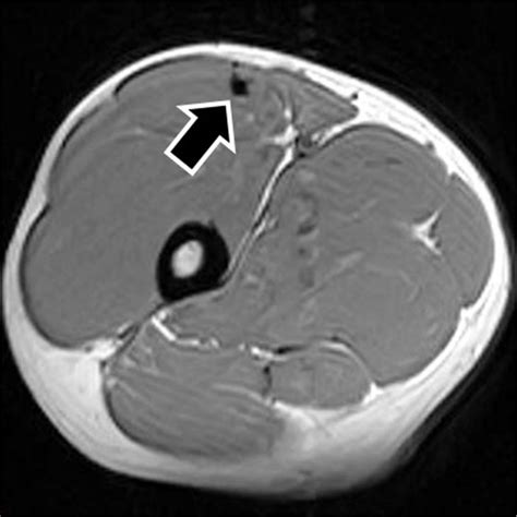 Pseudocyst of the central tendon. The figure shows an example of ...