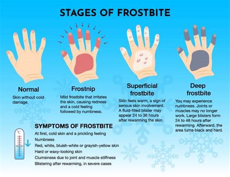 Frostbite Fingers Illustrations, Royalty-Free Vector Graphics & Clip Art - iStock