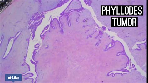 Phyllodes Tumor Youtube