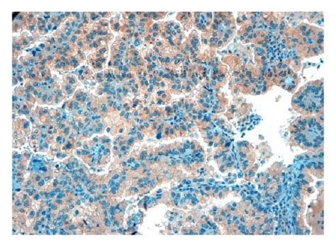 Representative Results Of Ihc Staining Of Nsclc Tumour Specimens For