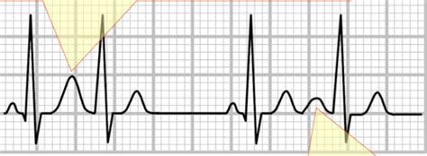 Arrhythmia Flashcards Quizlet