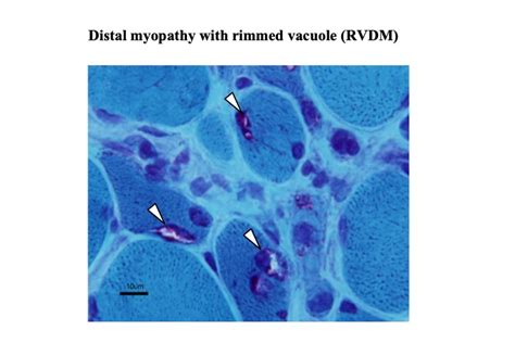 Musclediseases